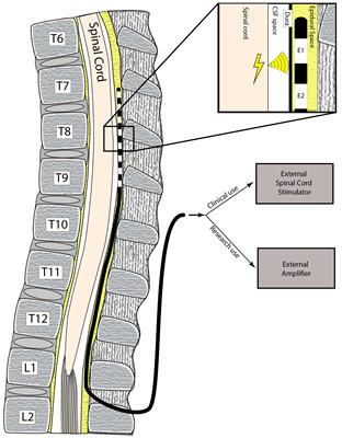 Epidural Spinal Electrogram Provides Direct Spinal Recordings in Awake Human Participants